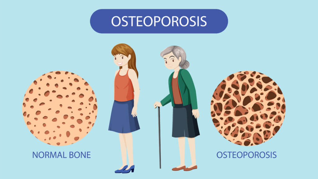 can osteoporosis be reversed